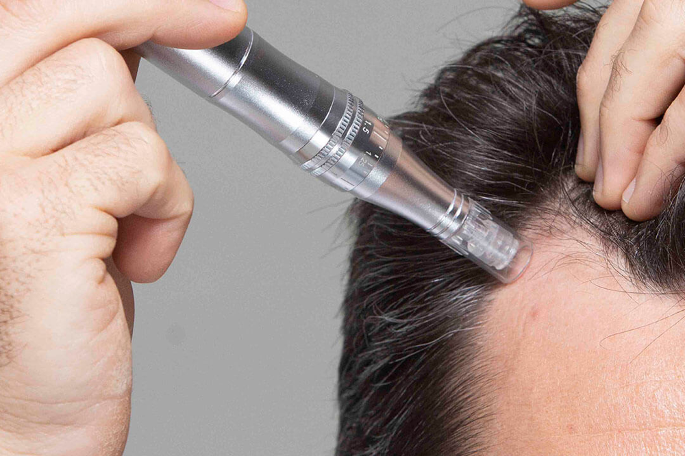 microneedling for hair loss