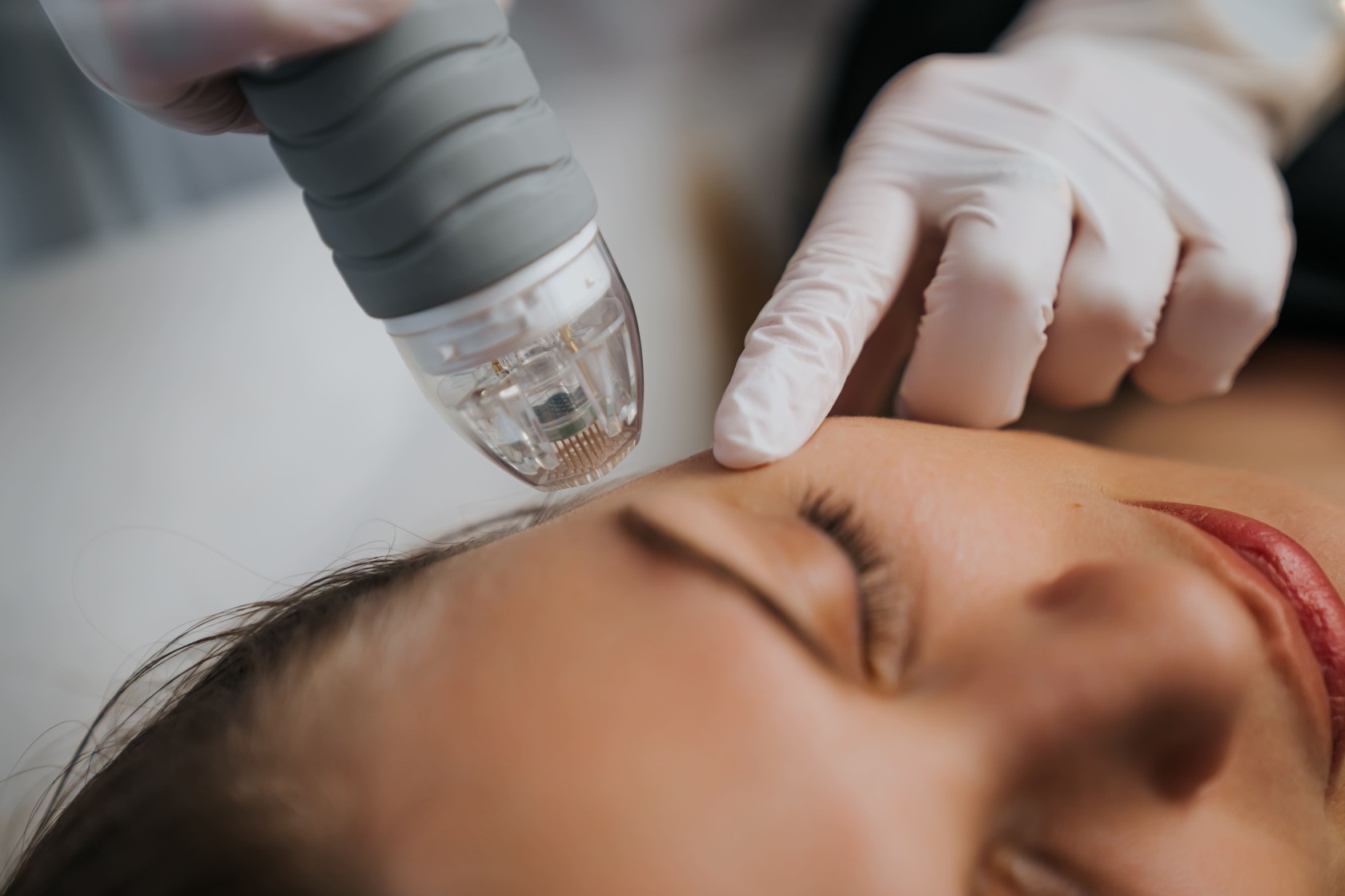Microneedling with Radiofrequency