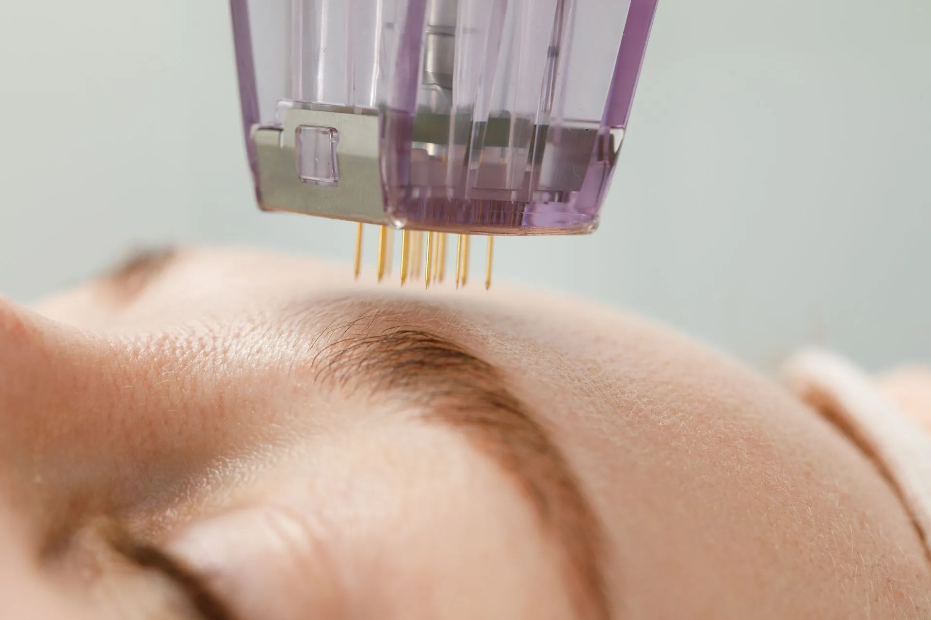 Rf Microneedling